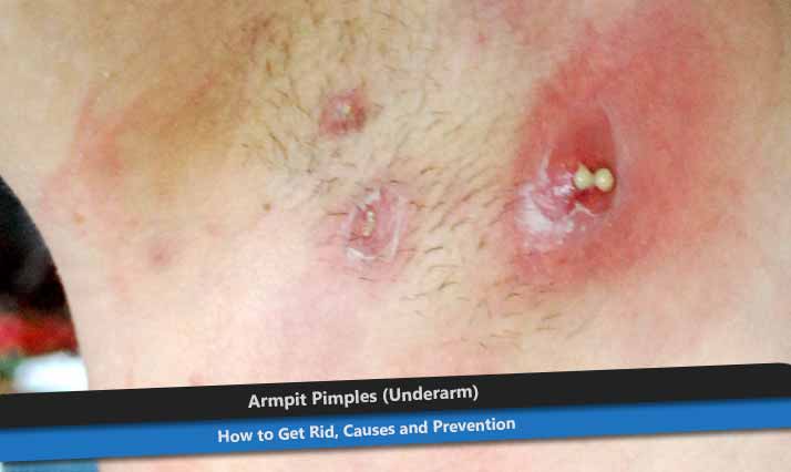 Armpit Pimples (Underarm)