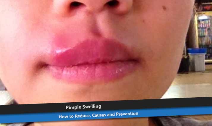Pimple Swelling on Lip.