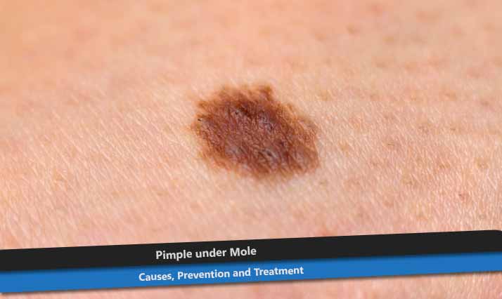 Pimple under Mole