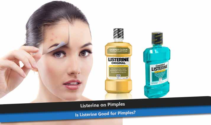 Listerine on Pimples