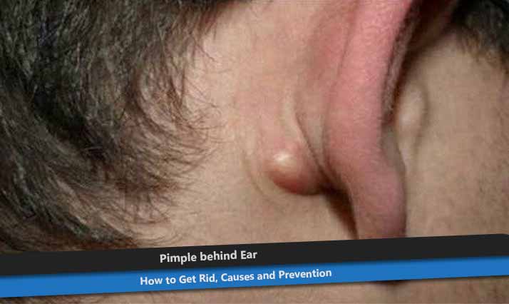 Pimple behind Ear