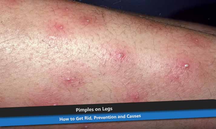 Pimples on Legs