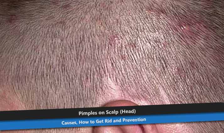 Pimples on Scalp or Head