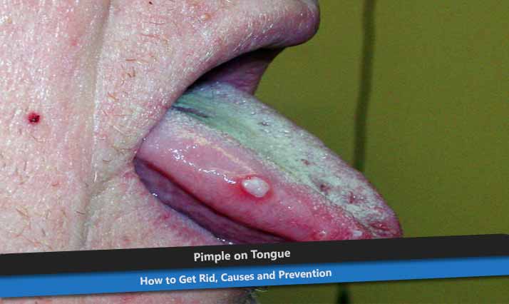White Pimple on Tongue