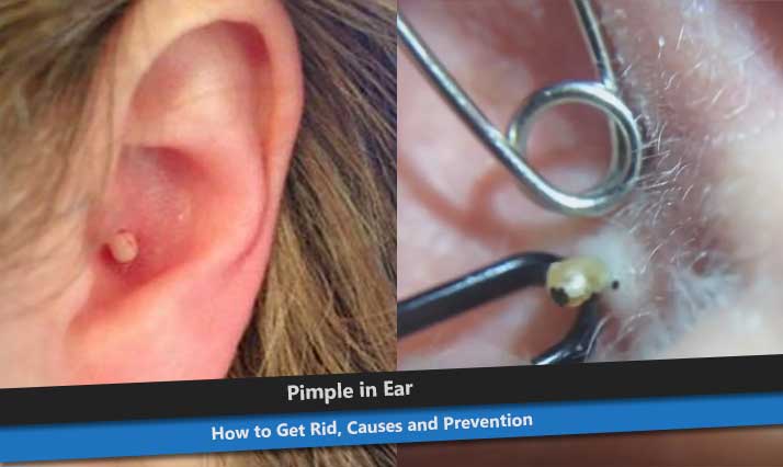 Pimple in Ear Canal