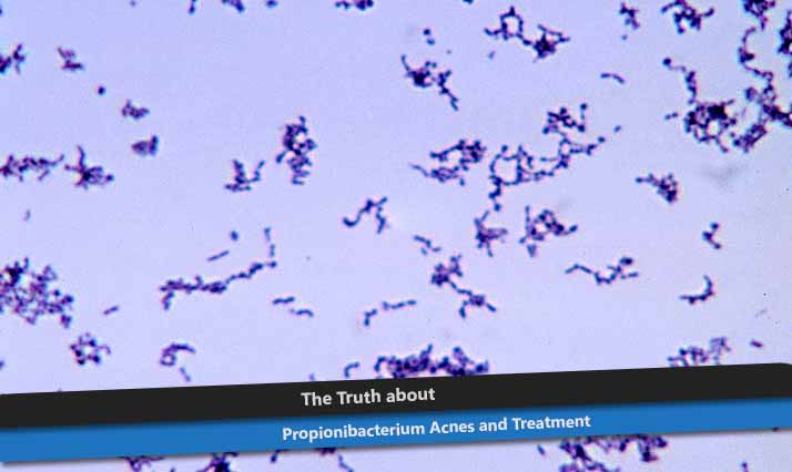 Propionibacterium Acnes
