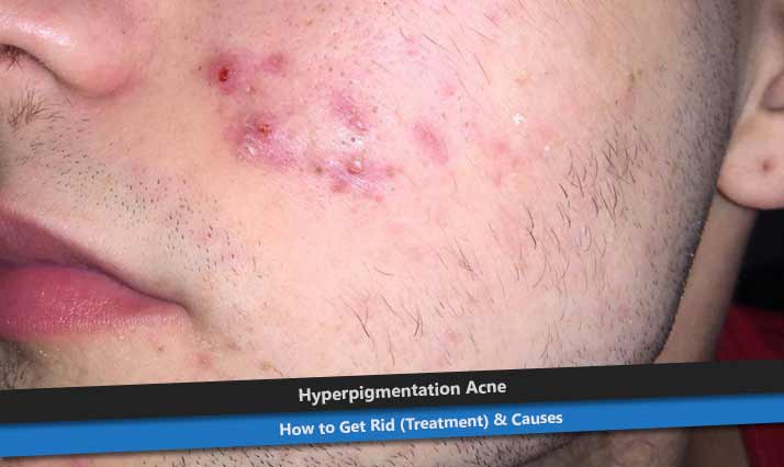 Hyperpigmentation Acne